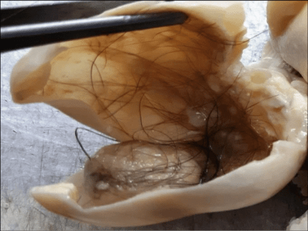 Panhysterectomy-specimen-of-cut-open-ovarian-mature-teratoma